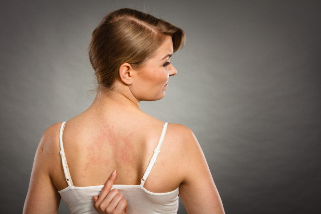 La importancia de los Omega-3 en dermatitis, psoriasis y eczemas